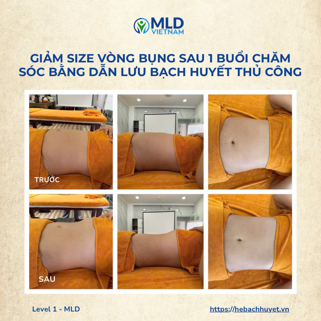 Vì sao vòng 2 nhỏ lại ngay sau buổi dẫn lưu bạch huyết (MLD)?