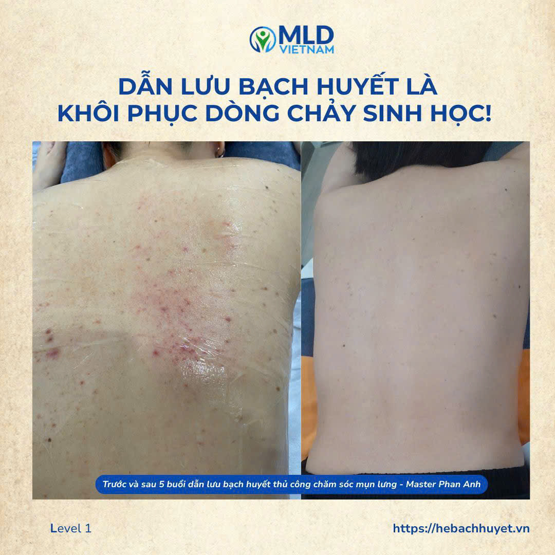 Các tác dụng chính của MLD đối với mụn lưng
