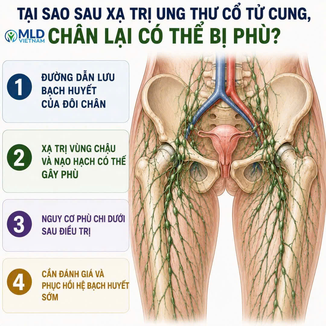 Tại sao sau khi xạ trị ung thư cổ tử cung, Chân lại có thể bị phù ?
