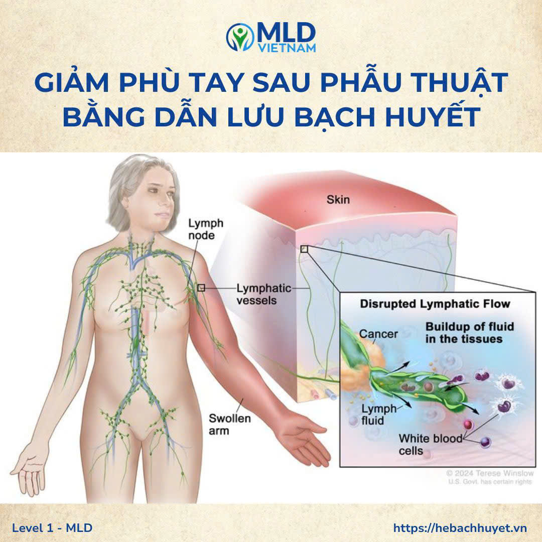 “Vì sao phù tay sau nạo vét hạch giảm tốt nhất bằng dẫn lưu bạch huyết?”