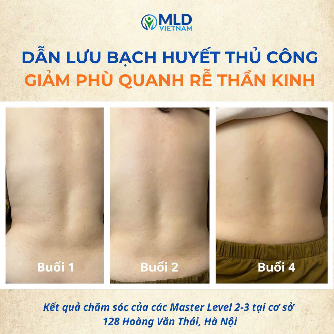 Phù lưng sau thoát vị đĩa đệm và đau mỏi thắt lưng mạn tính